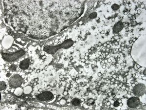 F,1y. | glycogenosis type II. (glycogen dissolved due to UA blockstaining) F,1y. | glycogenosis type II. (glycogen dissolved due to UA blockstaining)